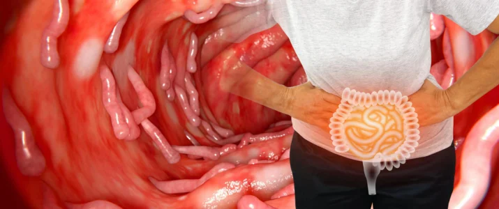 Pólipos no cólon (intestino grosso): Entenda o que são e o tratamento